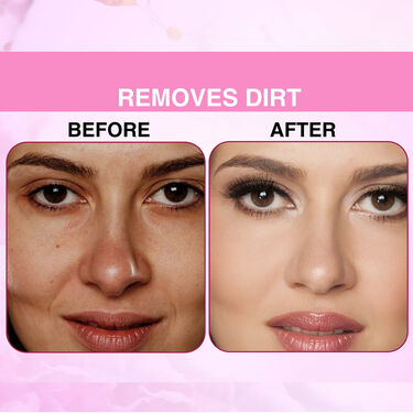 Instant Blackhead Remover Vacuum Suction Device (BVD)